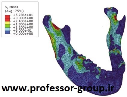 You are currently viewing آنالیز FEA در کاربردهای دندان پزشکی