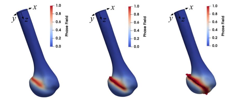 Read more about the article روش میدان فاز برای مدلسازی شکستگی استخوان های بلند