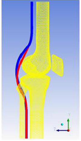 Read more about the article شبیه سازی اثرات گرمایی رگ های بزرگ خونی در مفصل زانو