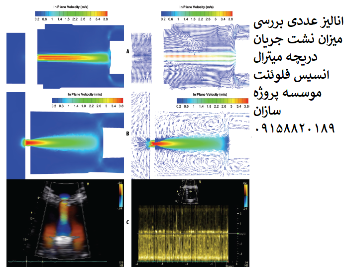 Read more about the article انالیز عددی بررسی میزان نشت جریان دریچه میترال انسیس فلوئنت