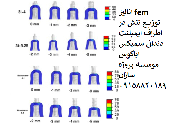 Read more about the article انالیز fem توزیع تنش در اطراف ایمپلنت دندانی میمیکس اباکوس