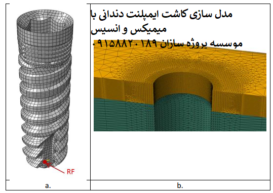 Read more about the article مدل سازی کاشت ایمپلنت دندانی با میمیکس و انسیس