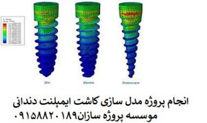 مدل سازی کاشت ایمپلنت