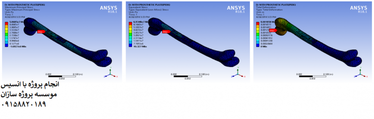 Read more about the article آنالیز FEA استخوان فمور شکسته با مواد پروتزی روکشدار HA