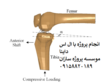 Read more about the article تحلیل  LS-DYNA پاسخ مفصل زانو انسان به بارگذاری تیبیال محوری