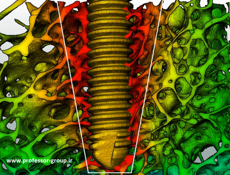 Read more about the article اثر متقابل ایمپلنت و استخوان