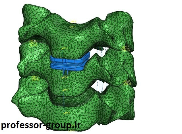 Read more about the article انجام پروژه شبیه سازی المان محدود آرتروپلاستی دیسک ستون فقرات