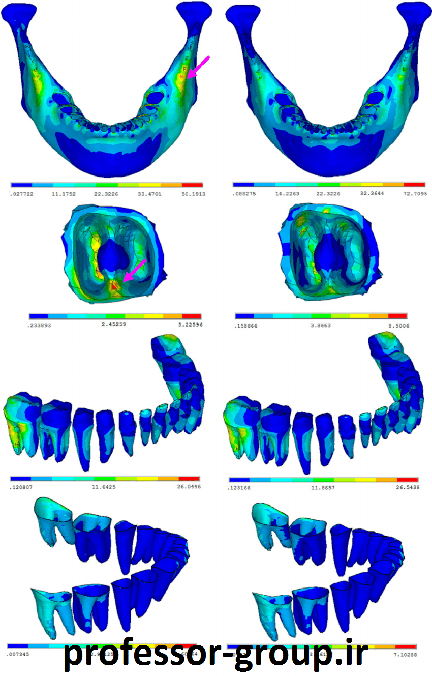 Read more about the article شبیه سازی المان محدود غیر ایزوتروپ آسیب مینای دندانی