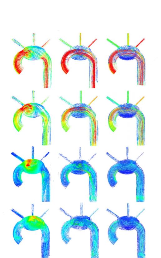 Read more about the article تحلیل همودینامیکی پیوند استنت در آنوریسم آئورت