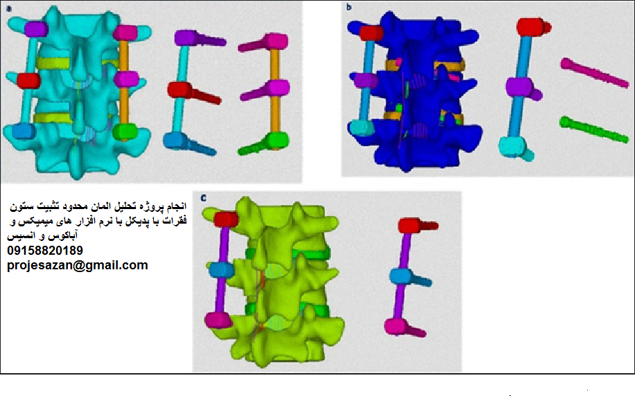 Read more about the article مطالعه اجزا محدود تثبیت پدیکل دو پایه ای ستون فقرات