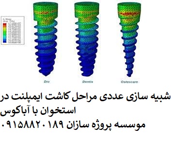 Read more about the article شبیه سازی عددی مراحل کاشت ایمپلنت در استخوان با آباکوس